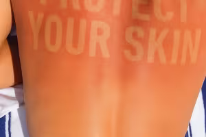Burn Lines Trend Sparks Global Warning from Skin Health Experts