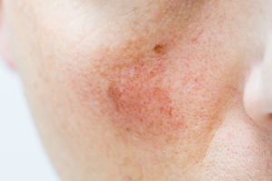 Rosacea Awareness Rises: A Friendly Guide to Managing the Skin Condition That Affects Millions