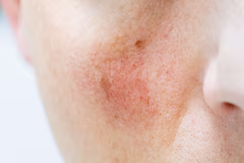 Rosacea Awareness Rises: A Friendly Guide to Managing the Skin Condition That Affects Millions