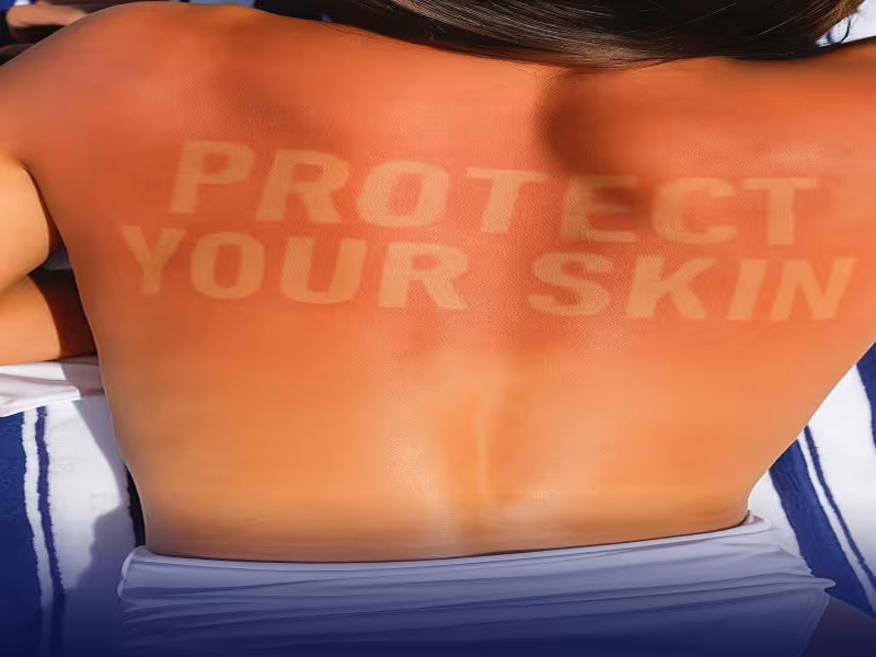Burn Lines Trend Sparks Global Warning from Skin Health Experts