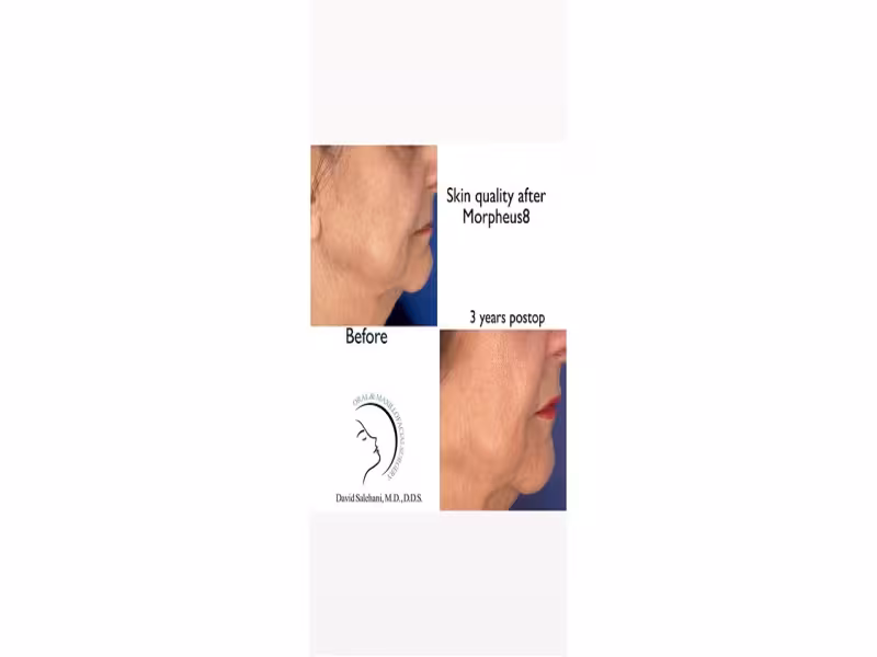 West Hollywood Surgeon Adds Morpheus8 Skin Tightening