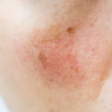 Rosacea Awareness Rises: A Friendly Guide to Managing the Skin Condition That Affects Millions
