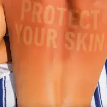 Burn Lines Trend Sparks Global Warning from Skin Health Experts